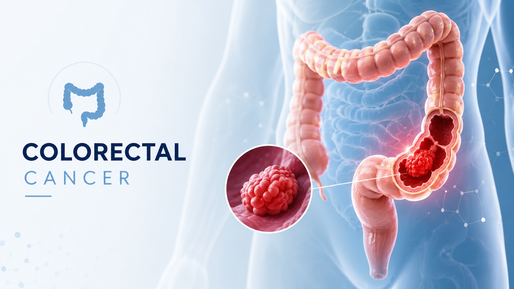 colorectal cancer